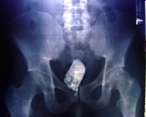 X-Ray Ur Anus