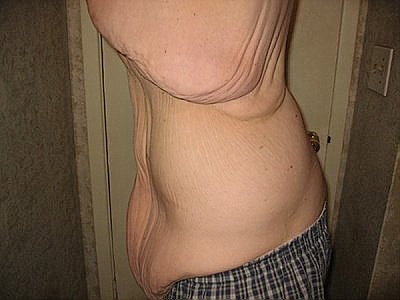 Gastric Bypass Surgery Before and After