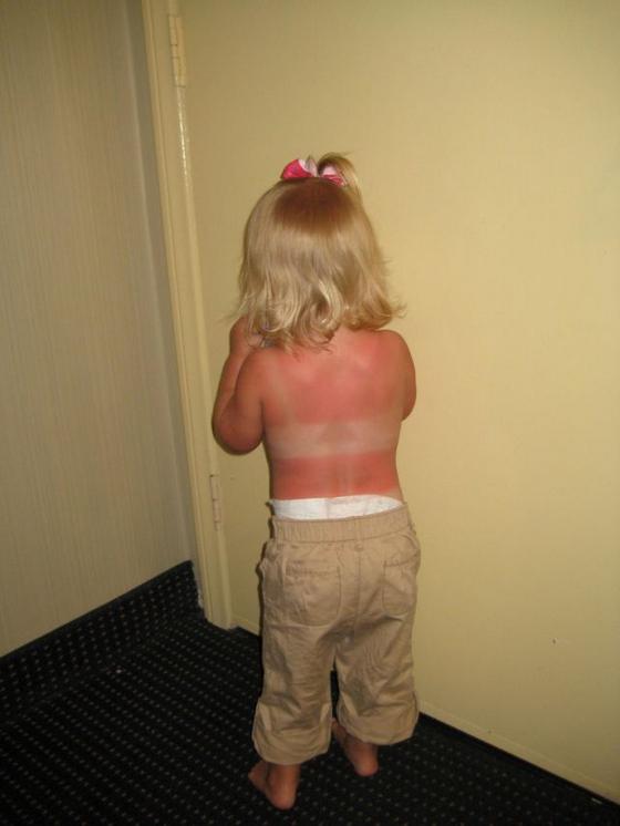 Always put sunscreen on your child 