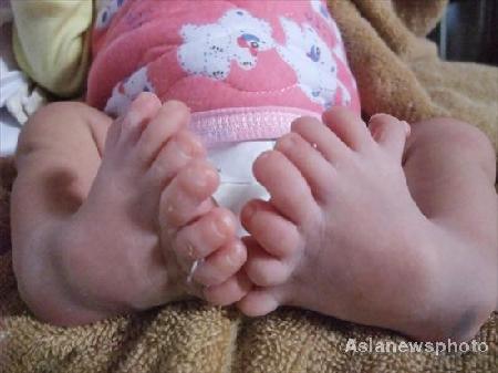 Baby Born with 8 Toes on Each Foot