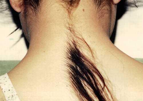 Hairy Genetic Mutations