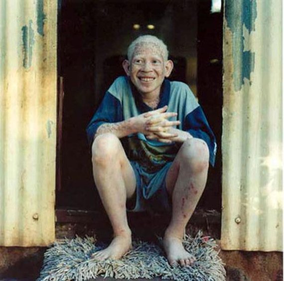 Albinos Around the World