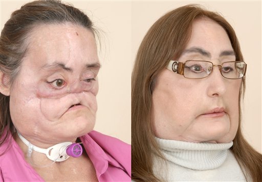 Connie Culp before and after the procedure.