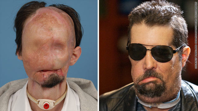 Dallas Wiens received a full face transplant about 2 months ago.  Here is the before and after.
