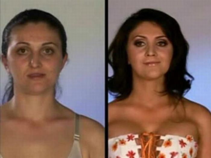 Befor and After Plastic Surgery