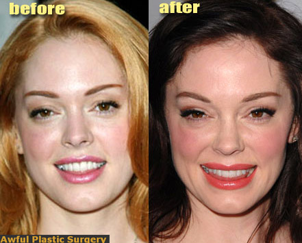 Celebrity Plastic Surgery