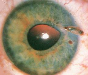 This is a prolapsed iris. I've never heard of it before either, but it looks horribly painful to me
