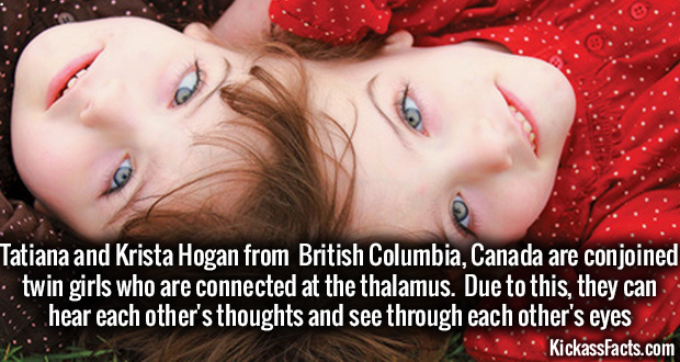 conjoined twins in head - Tatiana and Krista Hogan from British Columbia, Canada are conjoined twin girls who are connected at the thalamus. Due to this, they can hear each other's thoughts and see through each other's eyes KickassFacts.com