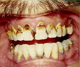 Worst teeth in the world!