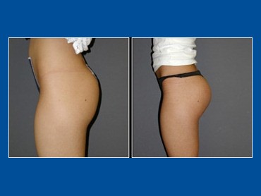 Butt Implants - Before and After