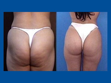 Butt Implants - Before and After