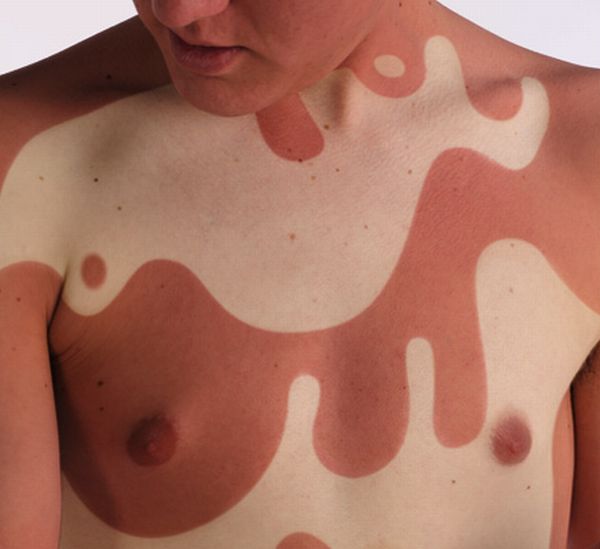 Sunburn Body Art