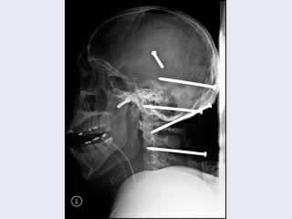 Worker somehow got 6 nails in his head in a normal day on the job