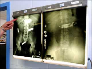 X-ray - AP Upright