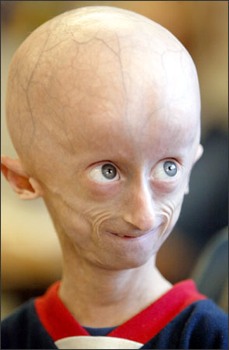 Hutchinson-Gilford Progeria Syndrome