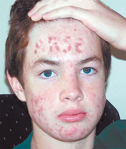 Kid's acne comes in... ARSE. It gained him the nickname of 'Craphead Slaphead'