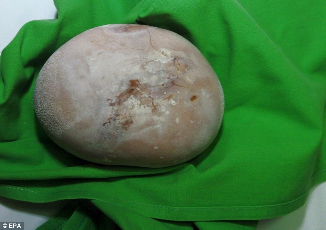 Man Has Kidney Stone the Size of a Coconut!!