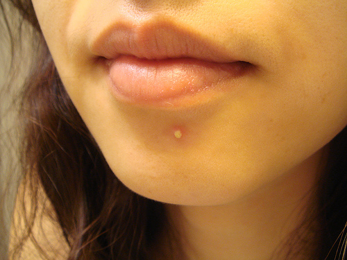 Zits, Acne, Pimples  GROSS!