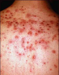 Zits, Acne, Pimples  GROSS!