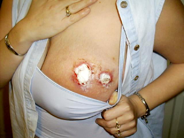 A brown recluse spider crawled into her shirt, Wounds are filled with antibiotic creme.