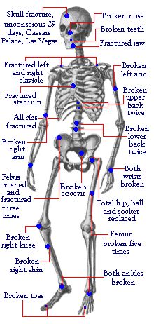 Evel Knievel injury diagram