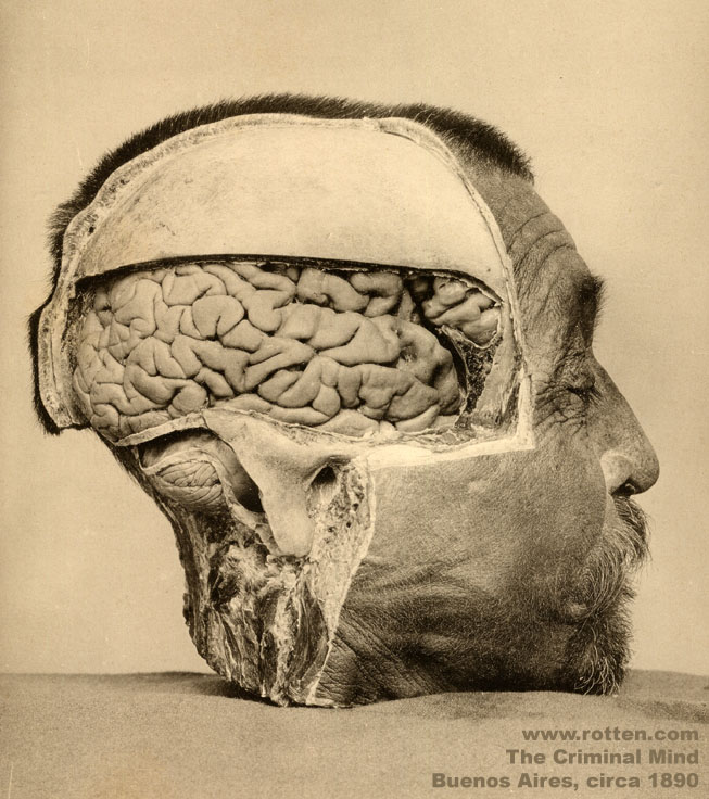 Dissection to investigate any differences between the mind of a Criminal and the mind of a Normal. At the time, phrenology had not been completely discredited, and physical abnormalities were thought to exist where in fact they do not.