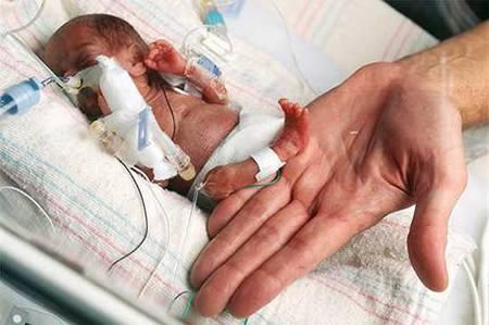 Smallest Living Baby - 9 inches, less than 8 ounces (Chicago)