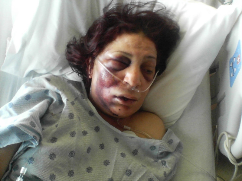 This is a picture of the woman whom was body slammed by police.  She was KO'd, suffered a concussion, broken teeth, lacerations on her face, bruises, and black eyes.