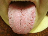  

Fissured tongue, also known as scrotal tongue is characterized by folds and fissures in the dorsal top surface of the tongue.  The fissures are of variable depth and usually extend laterally from a median groove as is pictured in the thumbnail. This condition does not cause any symptoms, unless food particles and debris lodge in the depths of 