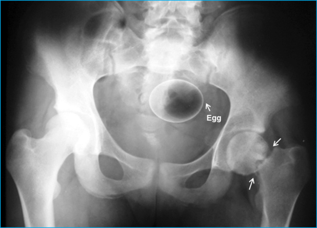 According to the Doc, the woman who shoved this egg in their butt thought it would cure her pelvic pain. True story.