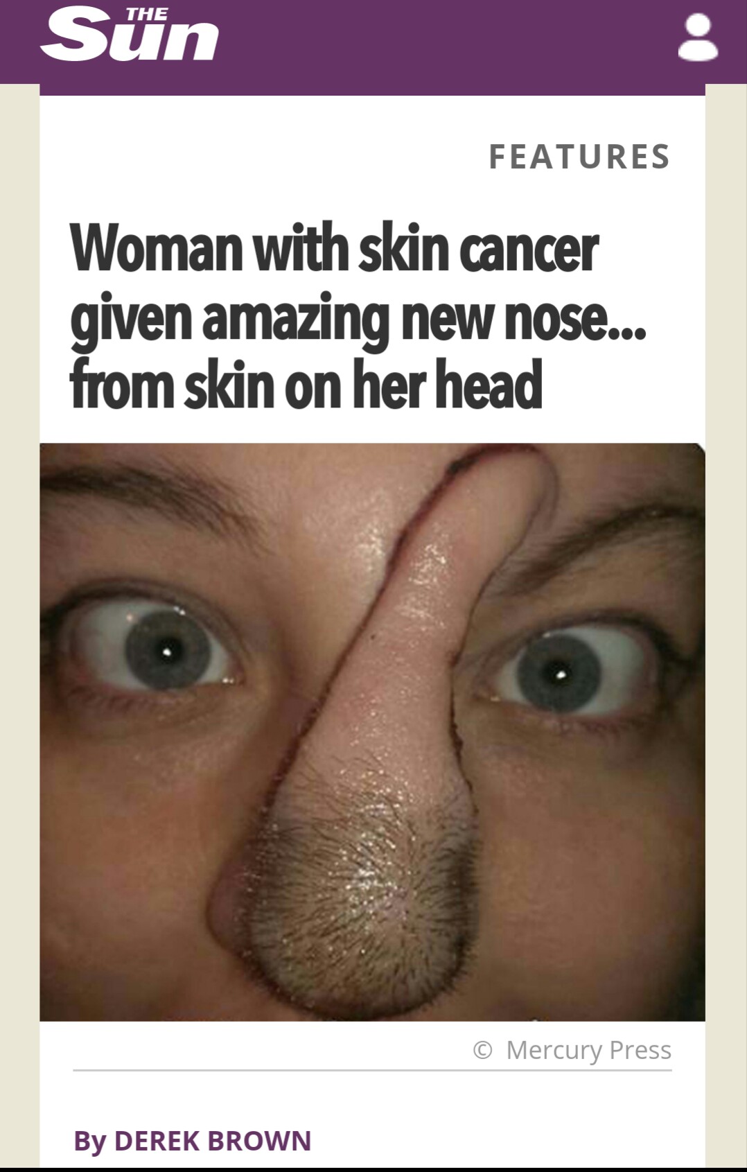 lip - The Sn Features Woman with skin cancer given amazing new nose... from skin on her head Mercury Press By Derek Brown