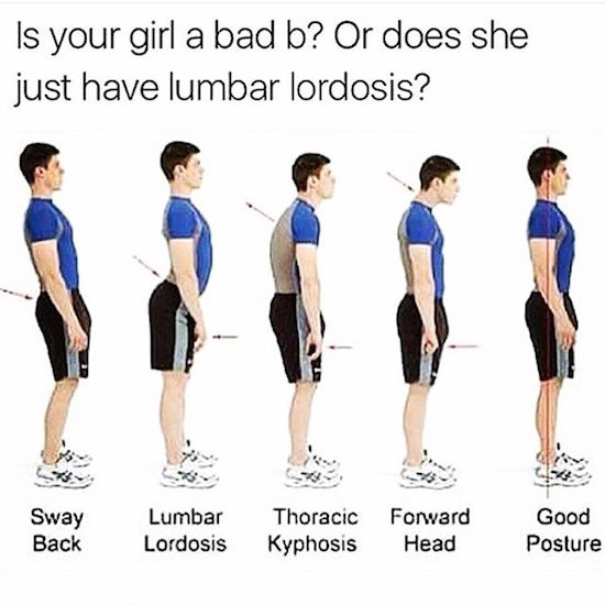 correct posture - Is your girl a bad b? Or does she just have lumbar lordosis? y Sway Back Lumbar Lordosis Thoracic Kyphosis Forward Head Good Posture