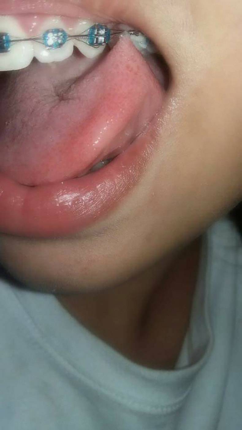 lip stuck in braces