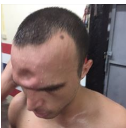 A fractured skull forced the fighter to forfeit the match. 