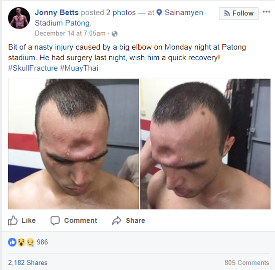 The injury occurred at the Patong Stadium in Thailand on Monday and required the French fighter known as Jeremy to have surgery on his forehead.