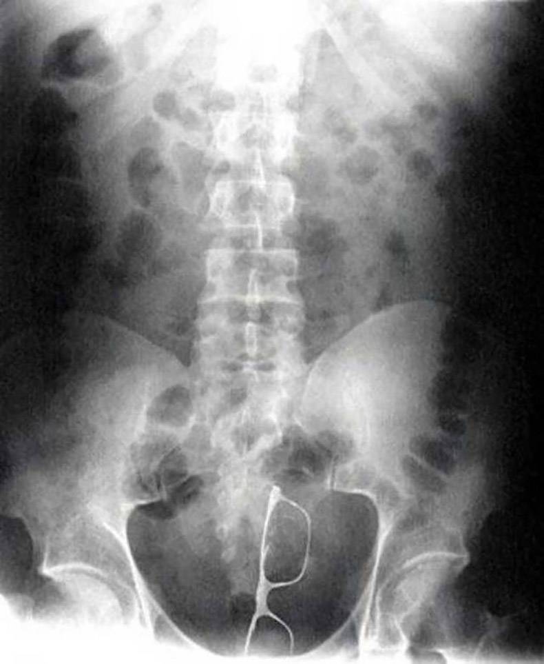 stuck up x ray