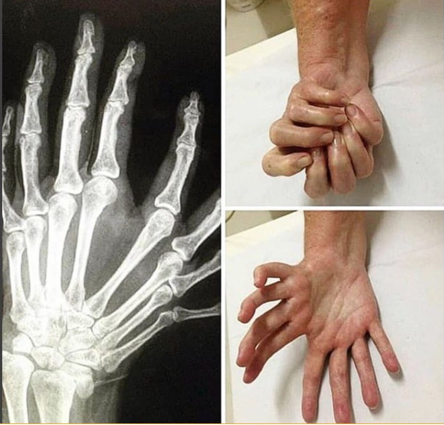 mirror hand syndrome