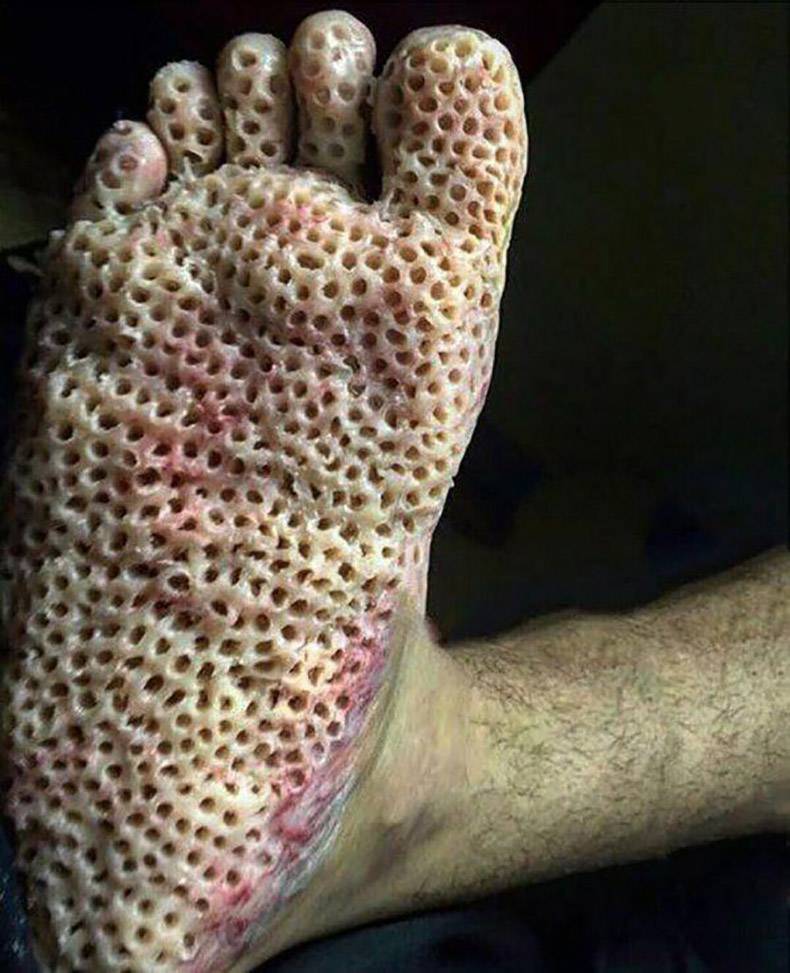 trypophobia leg