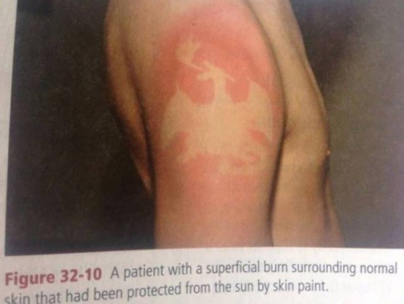 random pic knee - Figure 3210 A patient with a superficial burn surrounding normal skin that had been protected from the sun by skin paint.
