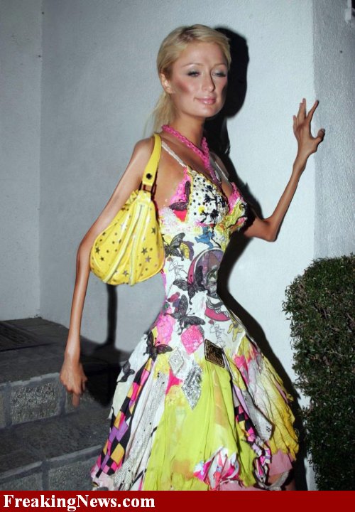 Celebrity Anorexia Pictures