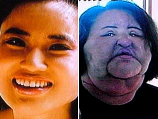 Before and after ... Hang Mioku, whose addiction to cosmetic surgery led her to inject cooking oil into her face
