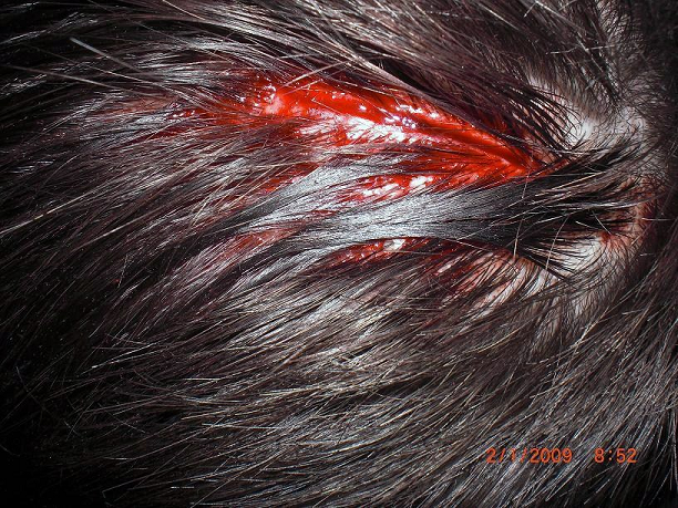 Extreme Head Laceration