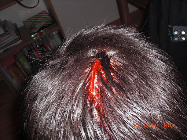 Extreme Head Laceration