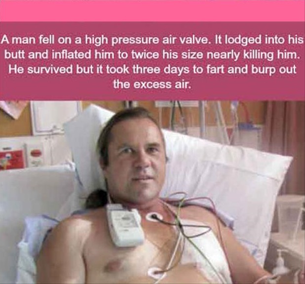shoulder - A man fell on a high pressure air valve. It lodged into his butt and inflated him to twice his size nearly killing him. He survived but it took three days to fart and burp out the excess air.