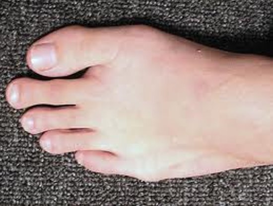 Mortons toe - when your second toe is bigger than your big toe