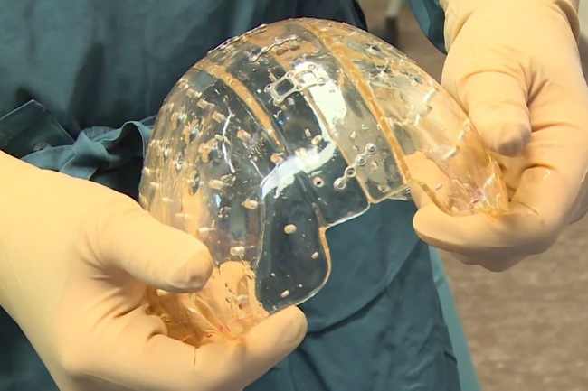 3d printed skull implant