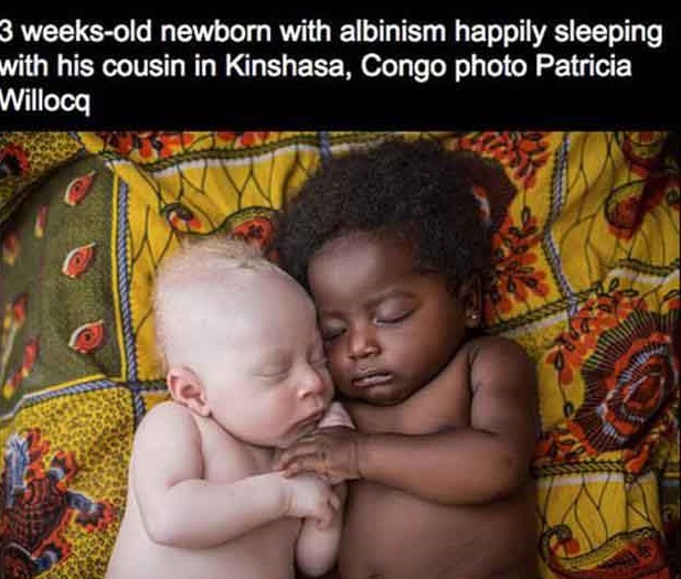 all humans are the same species - 3 weeksold newborn with albinism happily sleeping with his cousin in Kinshasa, Congo photo Patricia Willoca