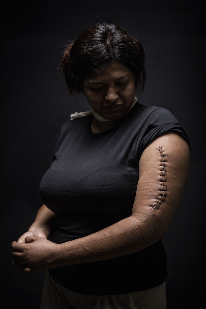 Mariana, 29 years old, Honduras. She was assaulted during her crossing as an undocumented person through Mexico with the intent to arrive in the United States. She was pushed by the assailants into a ravine, and was able to avoid an attempted rape