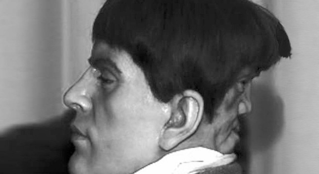 Edward Mordrake was born with a second face attached to the back of his head. The second face couldn't speak, but could laugh and cry separately from Edward's emotions... Edward called this face his "devil twin." He killed himself at 23 after doctors refused to remove it from his skull.