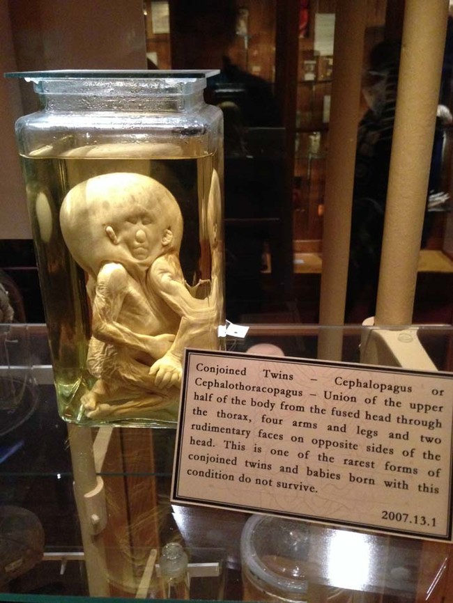These conjoined twins are some of the Mütter Museum's creepiest residents.